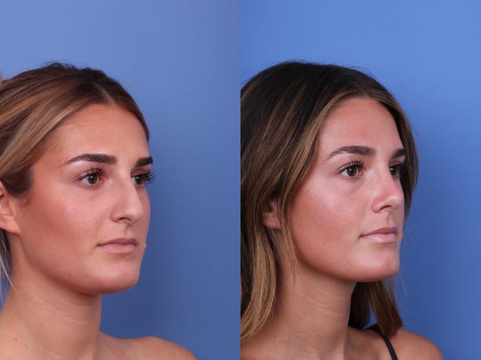 Before & After Rhinoplasty Case 675 Right Oblique View in Scottsdale, AZ
