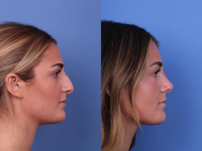Before & After Rhinoplasty Case 675 Right Side View in Scottsdale, AZ