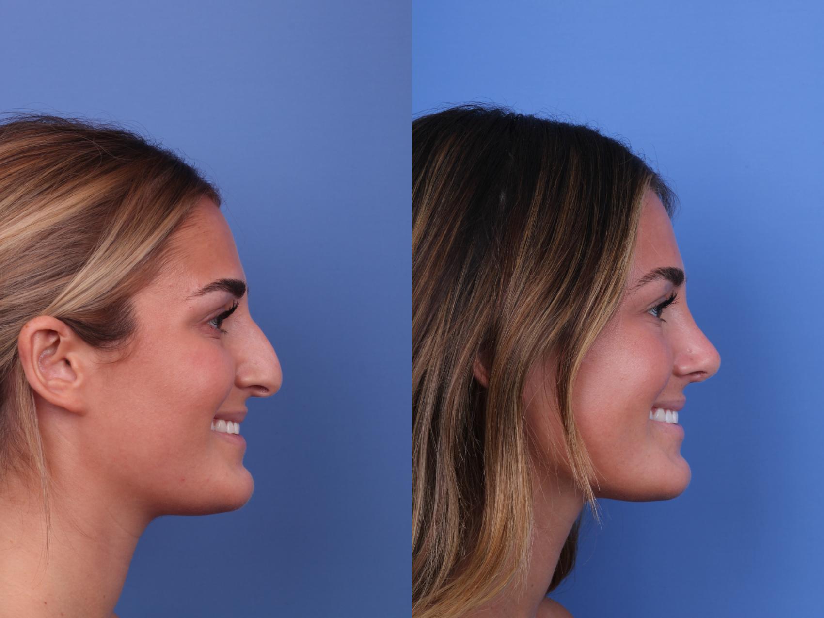 Before & After Rhinoplasty Case 675 Right Smile View in Scottsdale, AZ