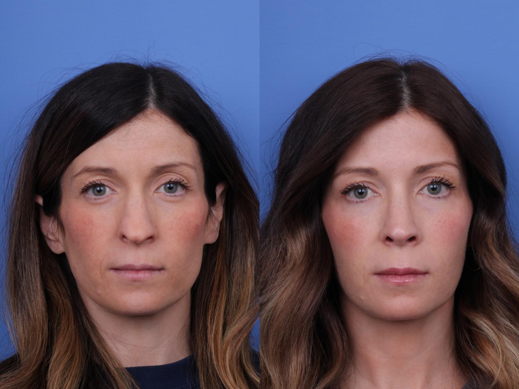 Before & After Rhinoplasty Case 677 Front View in Scottsdale, AZ