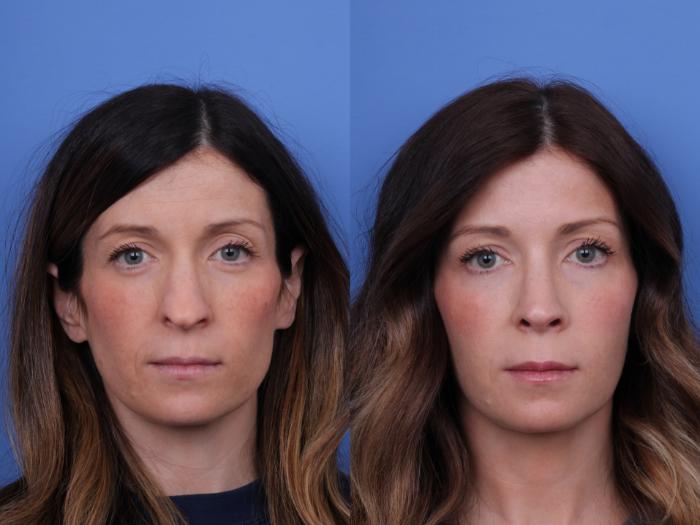 Before & After Rhinoplasty Case 677 Front View in Scottsdale, AZ