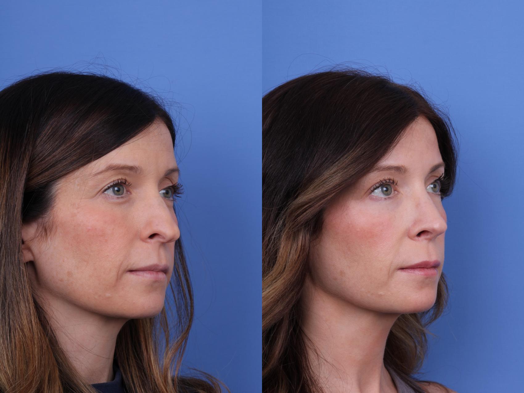 Before & After Rhinoplasty Case 677 Right Oblique View in Scottsdale, AZ