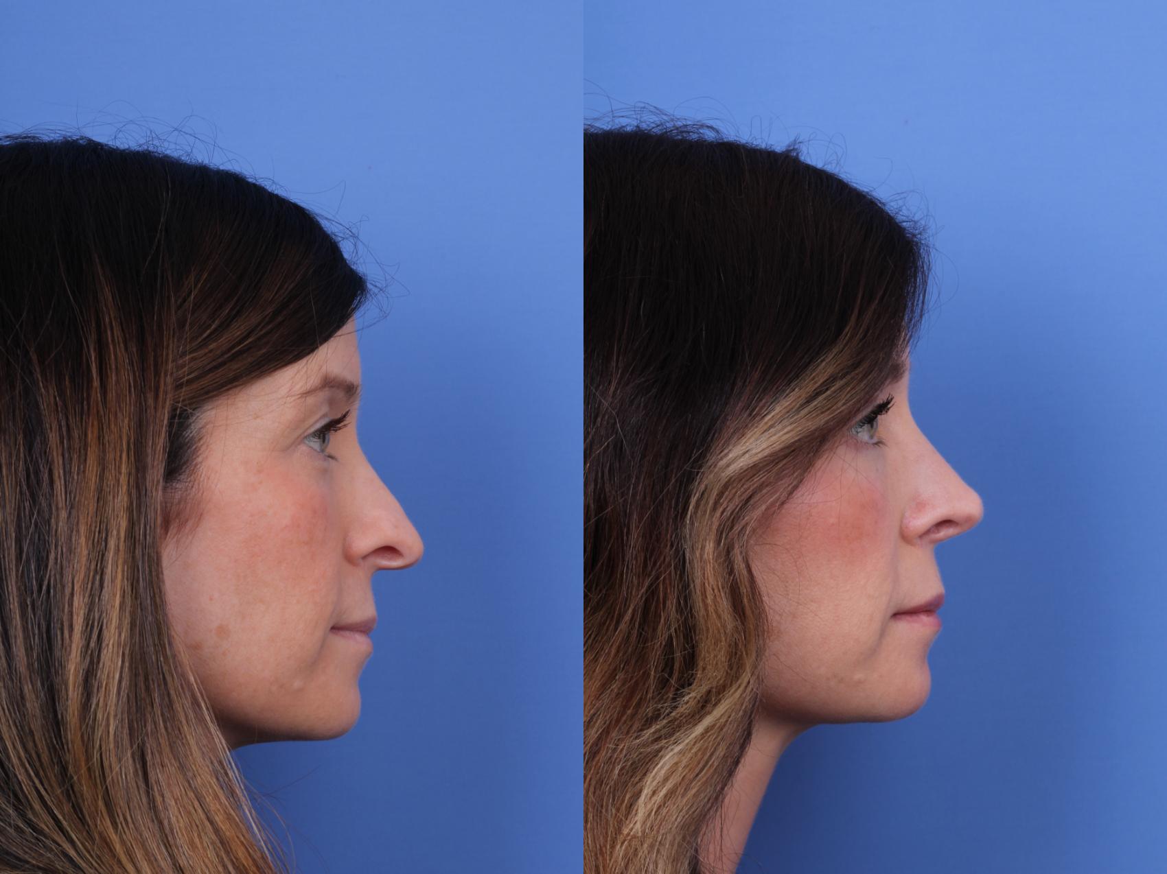Before & After Rhinoplasty Case 677 Right Side View in Scottsdale, AZ