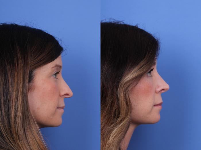 Before & After Rhinoplasty Case 677 Right Side View in Scottsdale, AZ