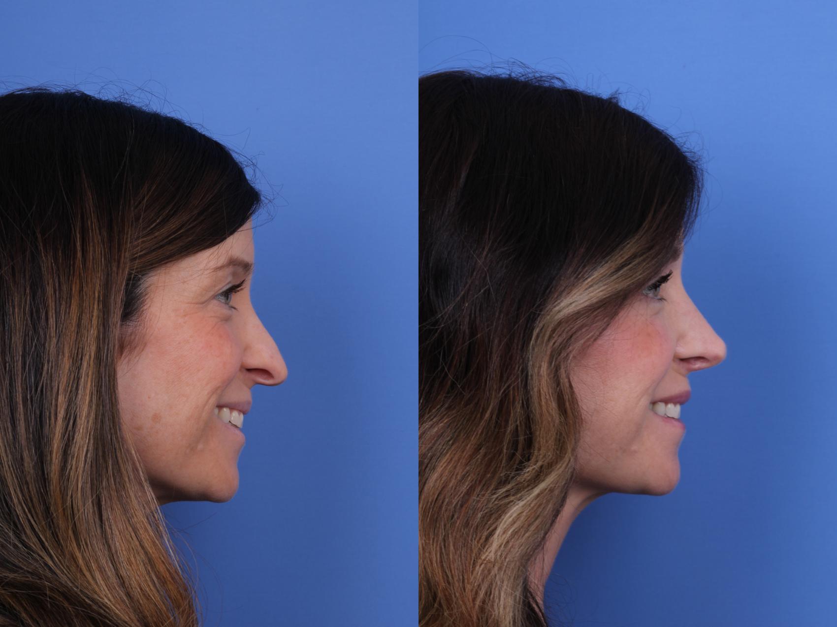 Before & After Rhinoplasty Case 677 Right Smile View in Scottsdale, AZ