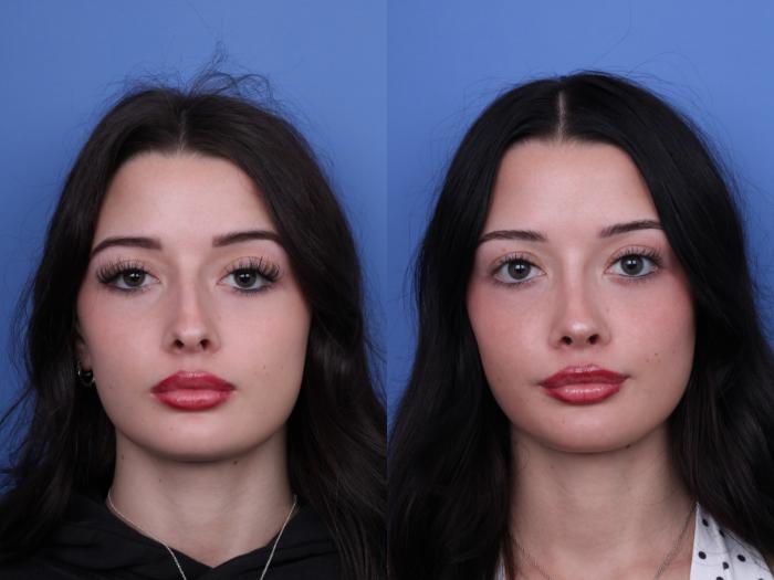 Before & After Rhinoplasty Case 679 Front View in Scottsdale, AZ