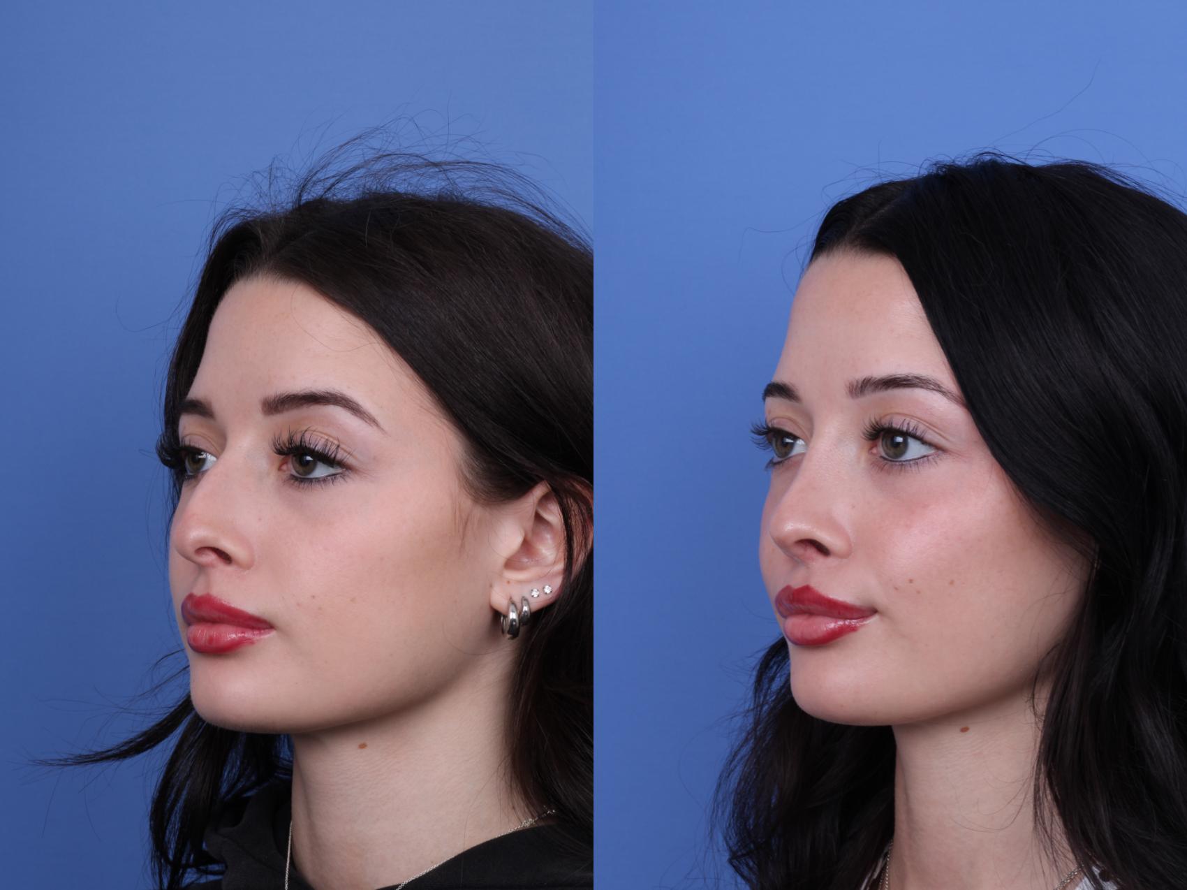 Before & After Rhinoplasty Case 679 Left Oblique View in Scottsdale, AZ