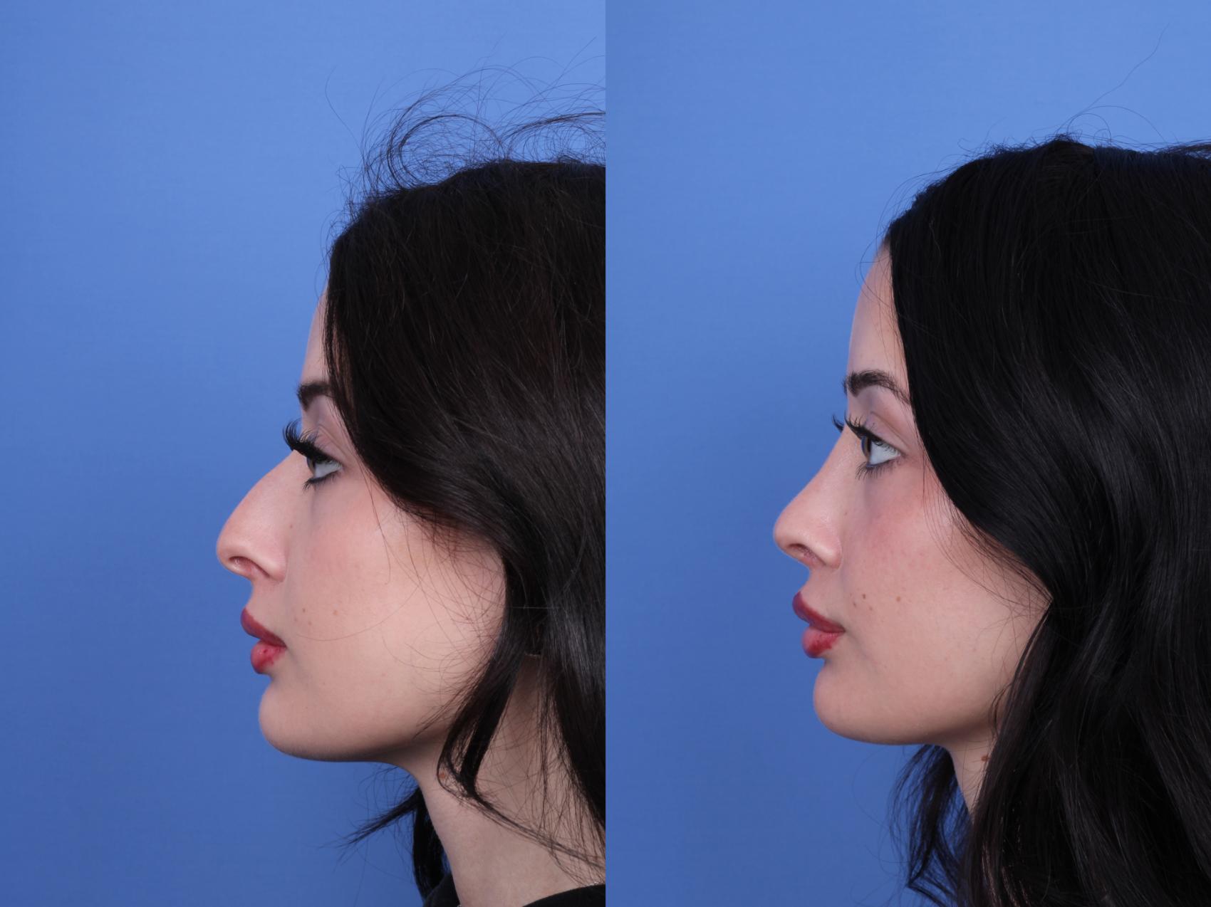 Before & After Rhinoplasty Case 679 Left Side View in Scottsdale, AZ