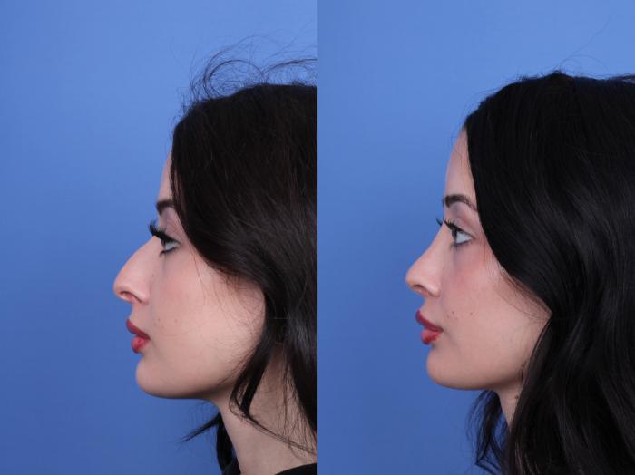 Before & After Rhinoplasty Case 679 Left Side View in Scottsdale, AZ