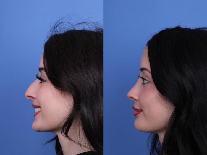 Before & After Rhinoplasty Case 679 Left Smile View in Scottsdale, AZ