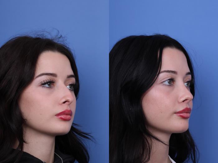 Before & After Rhinoplasty Case 679 Right Oblique View in Scottsdale, AZ