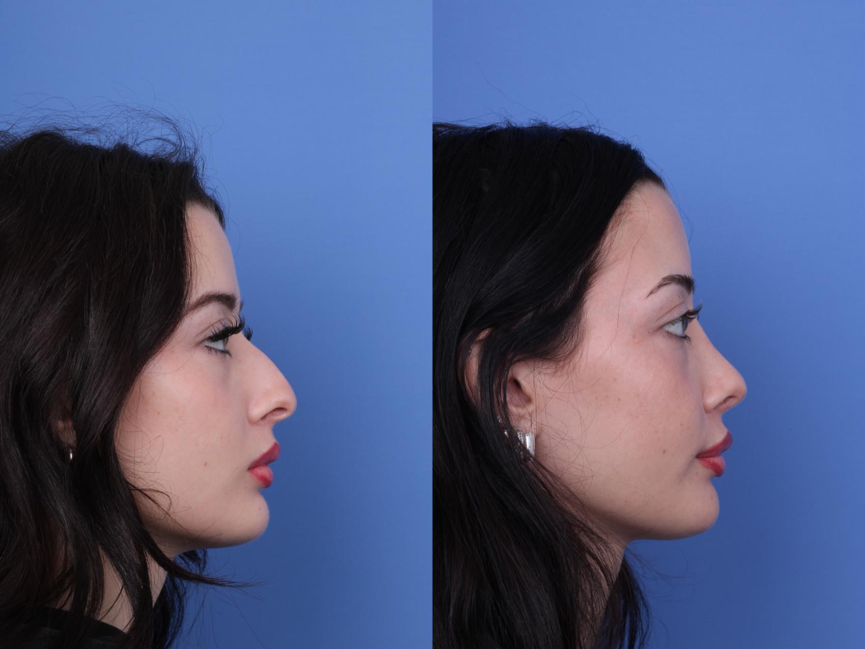 Before & After Rhinoplasty Case 679 Right Side View in Scottsdale, AZ