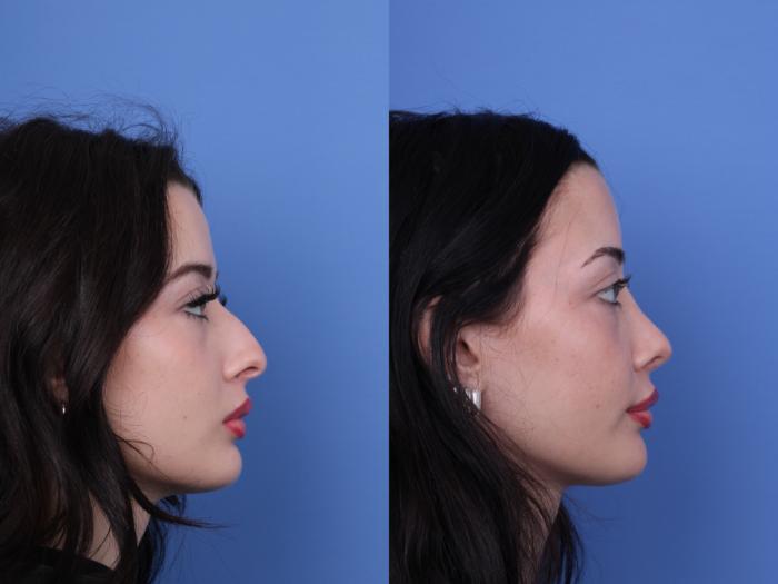 Before & After Rhinoplasty Case 679 Right Side View in Scottsdale, AZ