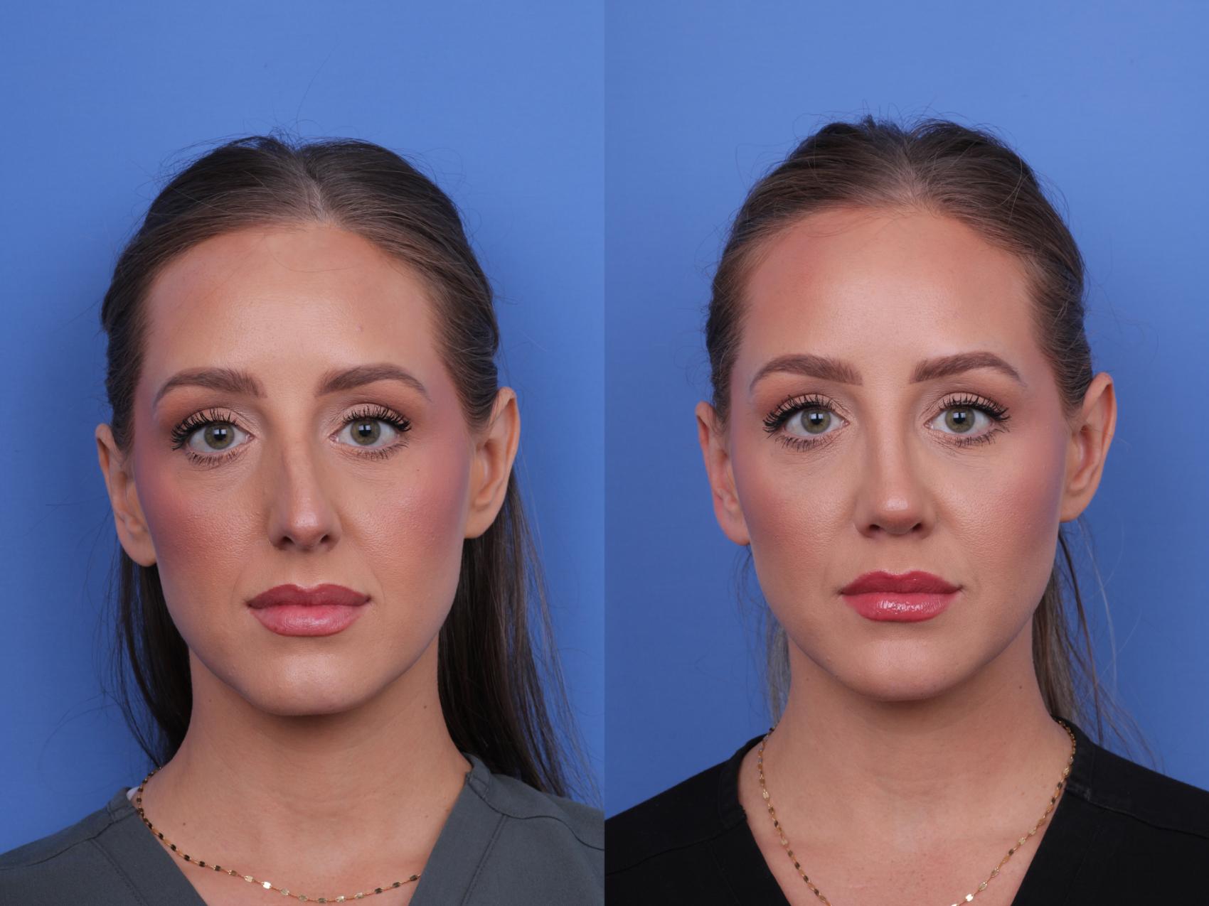 Before & After Rhinoplasty Case 680 Front View in Scottsdale, AZ