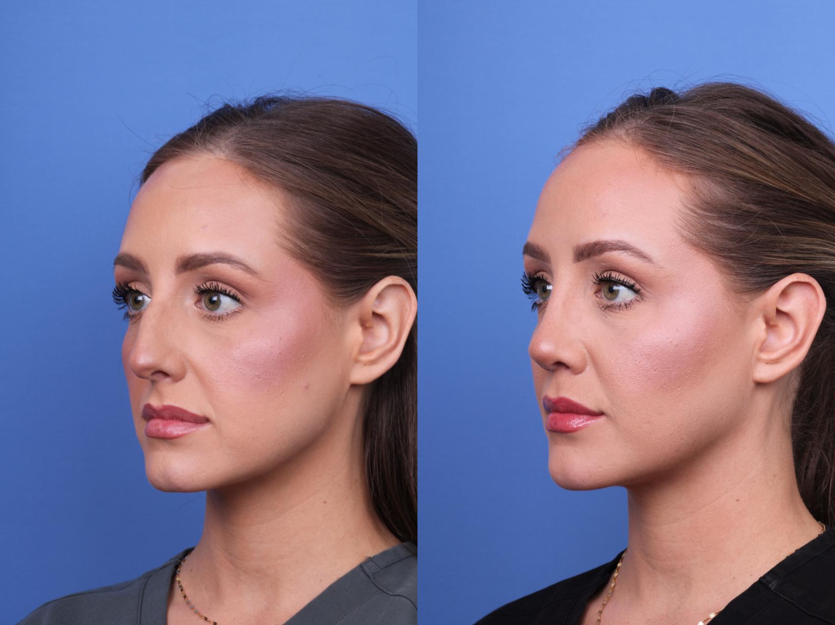Before & After Rhinoplasty Case 680 Left Oblique View in Scottsdale, AZ