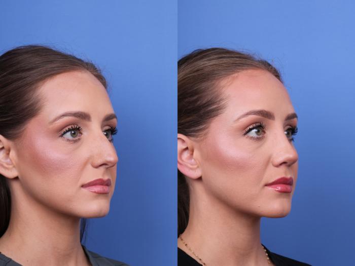 Before & After Rhinoplasty Case 680 Right Oblique View in Scottsdale, AZ