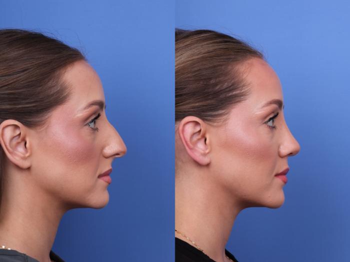 Before & After Rhinoplasty Case 680 Right Side View in Scottsdale, AZ