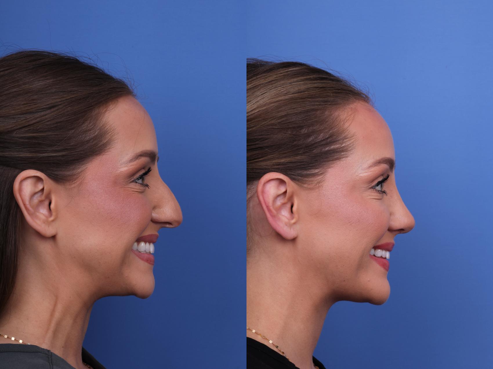 Before & After Rhinoplasty Case 680 Right Smile View in Scottsdale, AZ