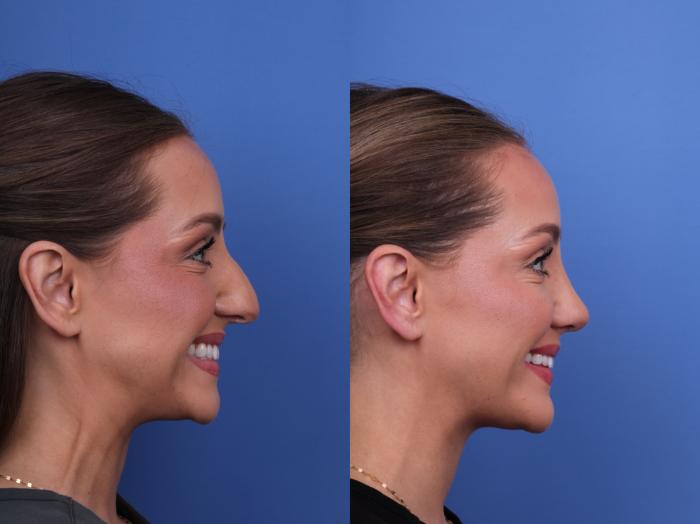 Before & After Rhinoplasty Case 680 Right Smile View in Scottsdale, AZ