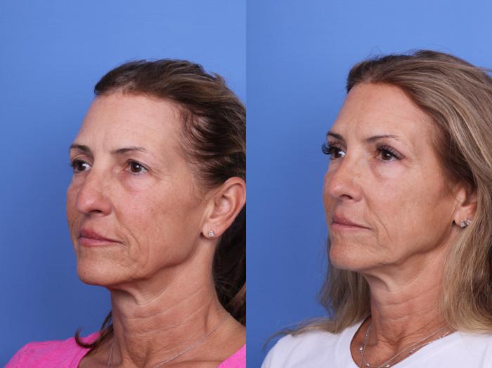 Before & After Rhinoplasty Case 681 Left Oblique View in Scottsdale, AZ