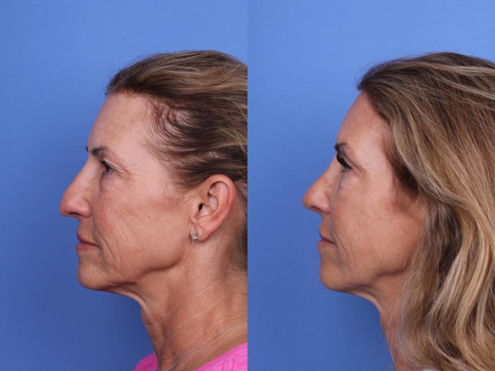 Before & After Rhinoplasty Case 681 Left Side View in Scottsdale, AZ