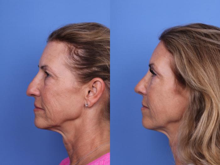 Before & After Rhinoplasty Case 681 Left Side View in Scottsdale, AZ