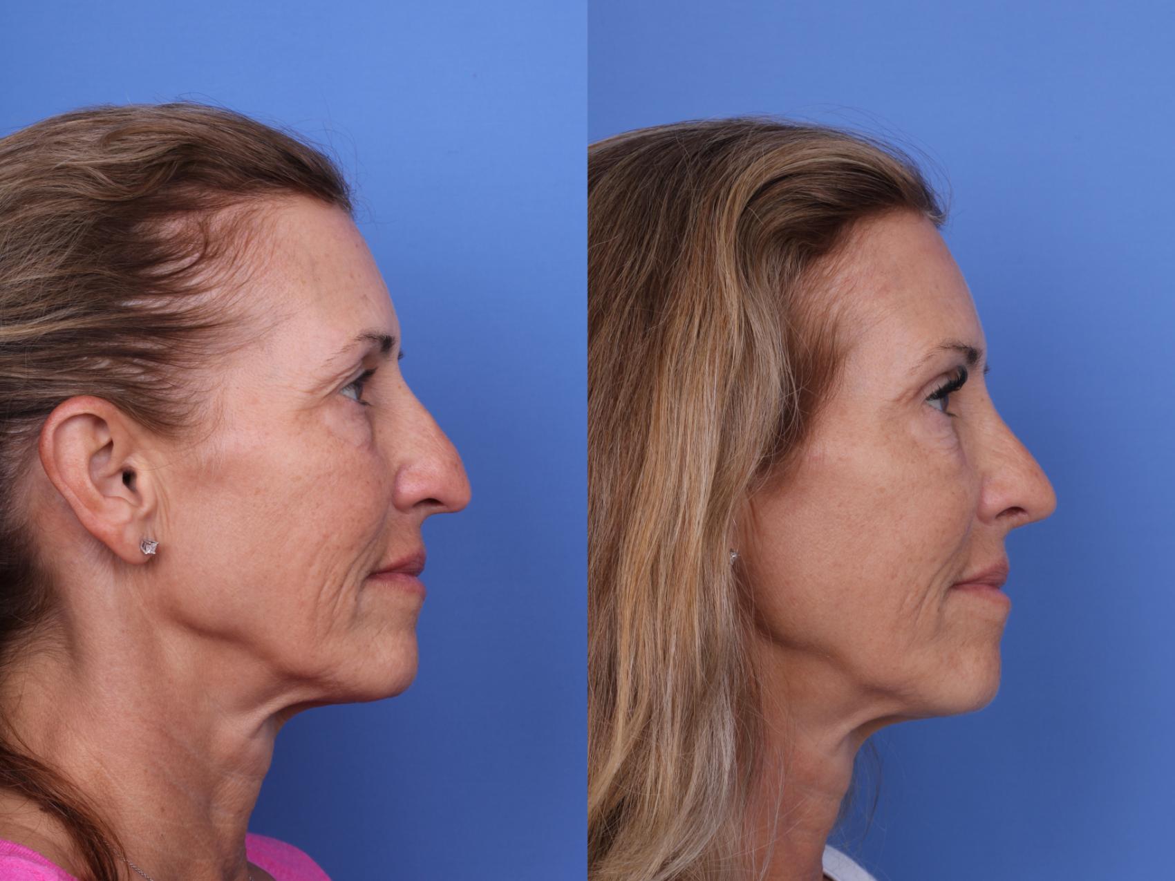 Before & After Rhinoplasty Case 681 Right Side View in Scottsdale, AZ