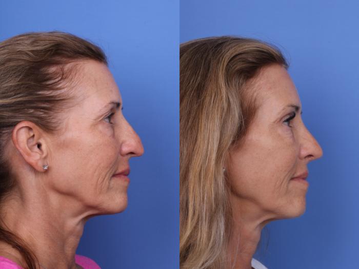 Before & After Rhinoplasty Case 681 Right Side View in Scottsdale, AZ