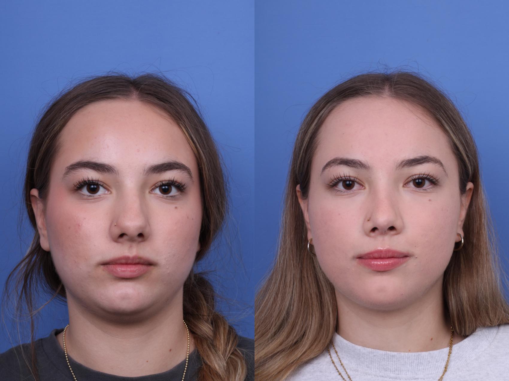 Before & After Rhinoplasty Case 683 Front View in Scottsdale, AZ