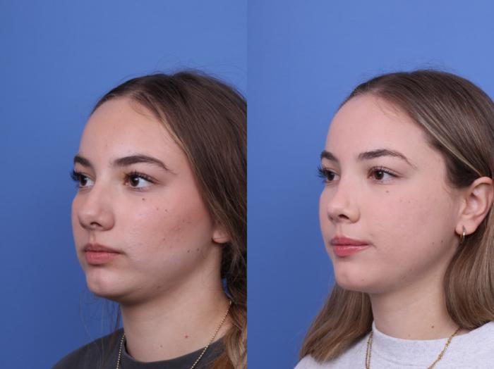 Before & After Rhinoplasty Case 683 Left Oblique View in Scottsdale, AZ