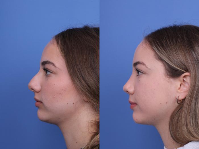 Before & After Rhinoplasty Case 683 Left Side View in Scottsdale, AZ