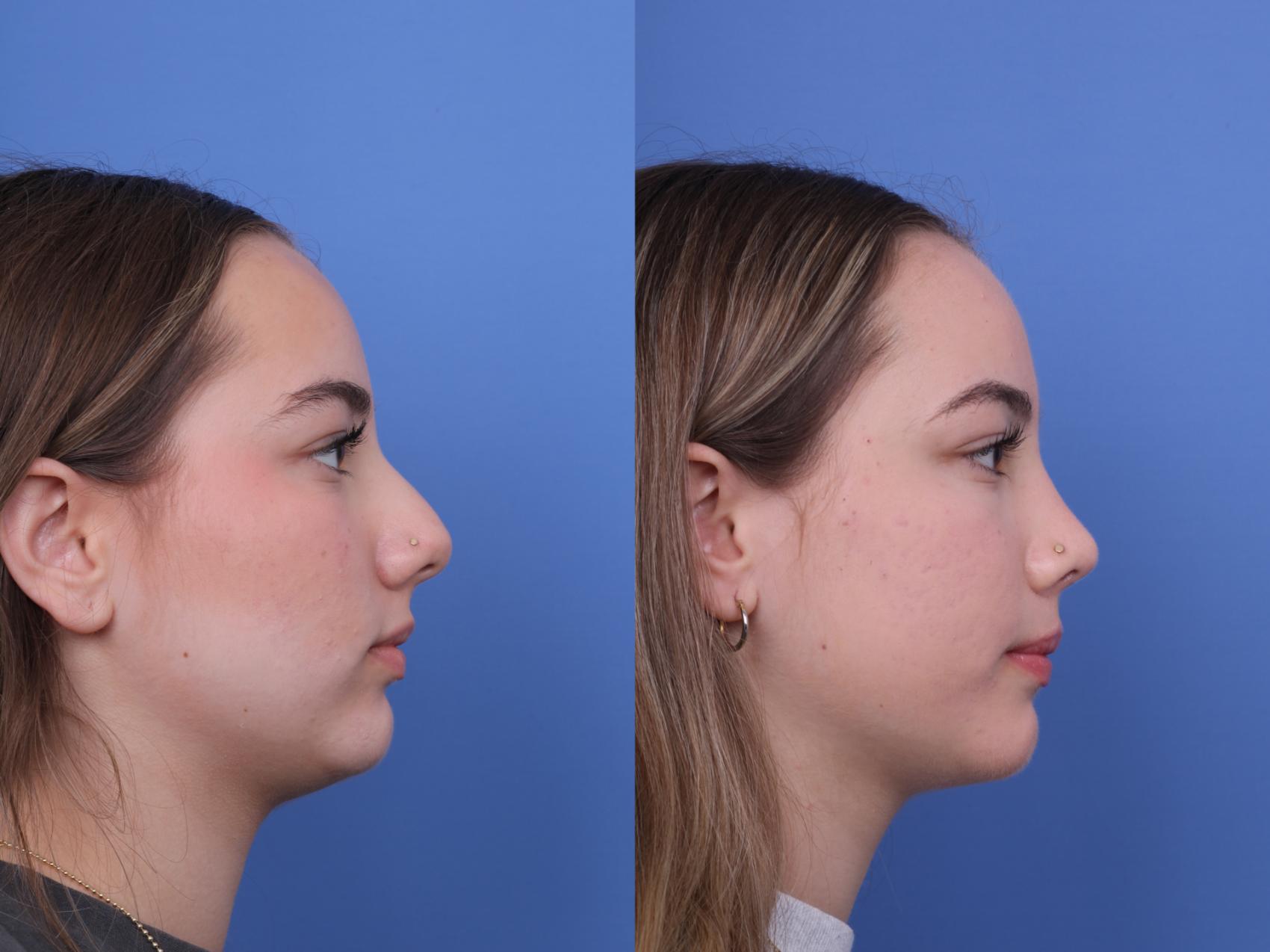 Before & After Rhinoplasty Case 683 Right Side View in Scottsdale, AZ