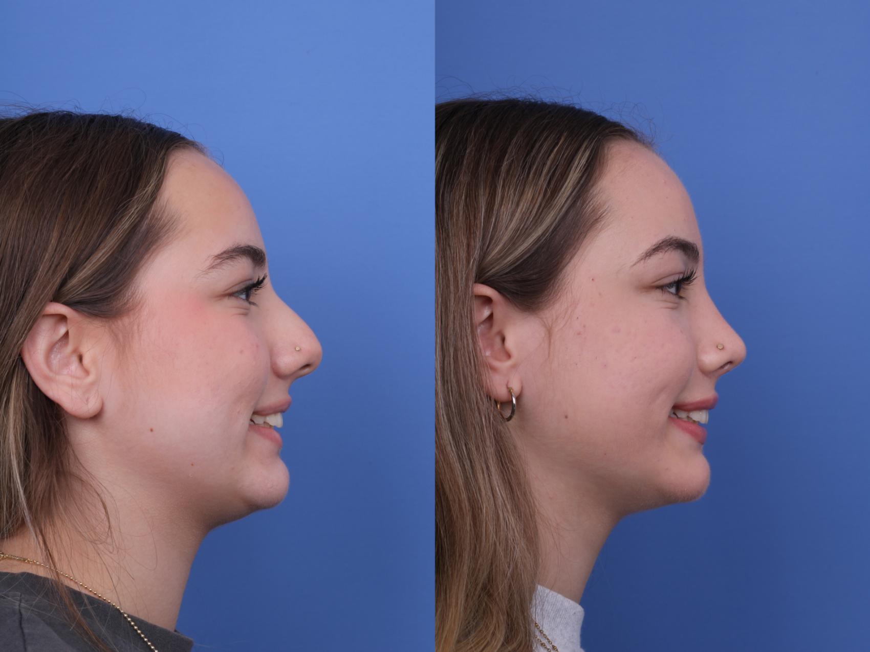 Before & After Rhinoplasty Case 683 Right Smile View in Scottsdale, AZ