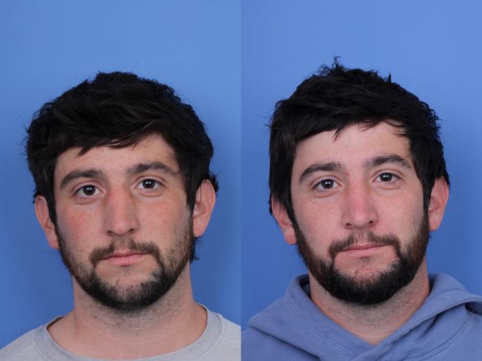 Before & After Rhinoplasty Case 684 Front View in Scottsdale, AZ