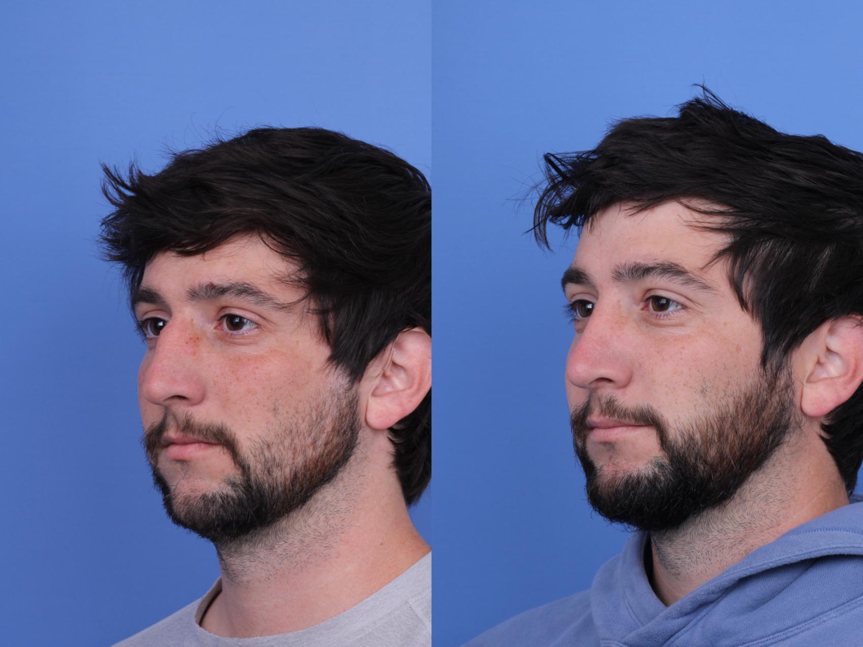 Before & After Rhinoplasty Case 684 Left Oblique View in Scottsdale, AZ