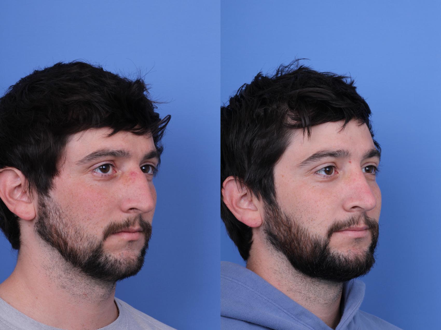 Before & After Rhinoplasty Case 684 Right Oblique View in Scottsdale, AZ