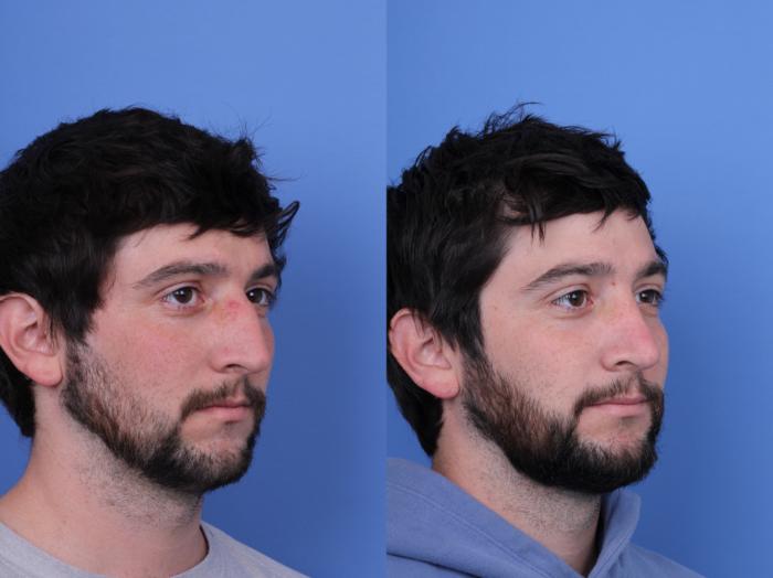 Before & After Rhinoplasty Case 684 Right Oblique View in Scottsdale, AZ