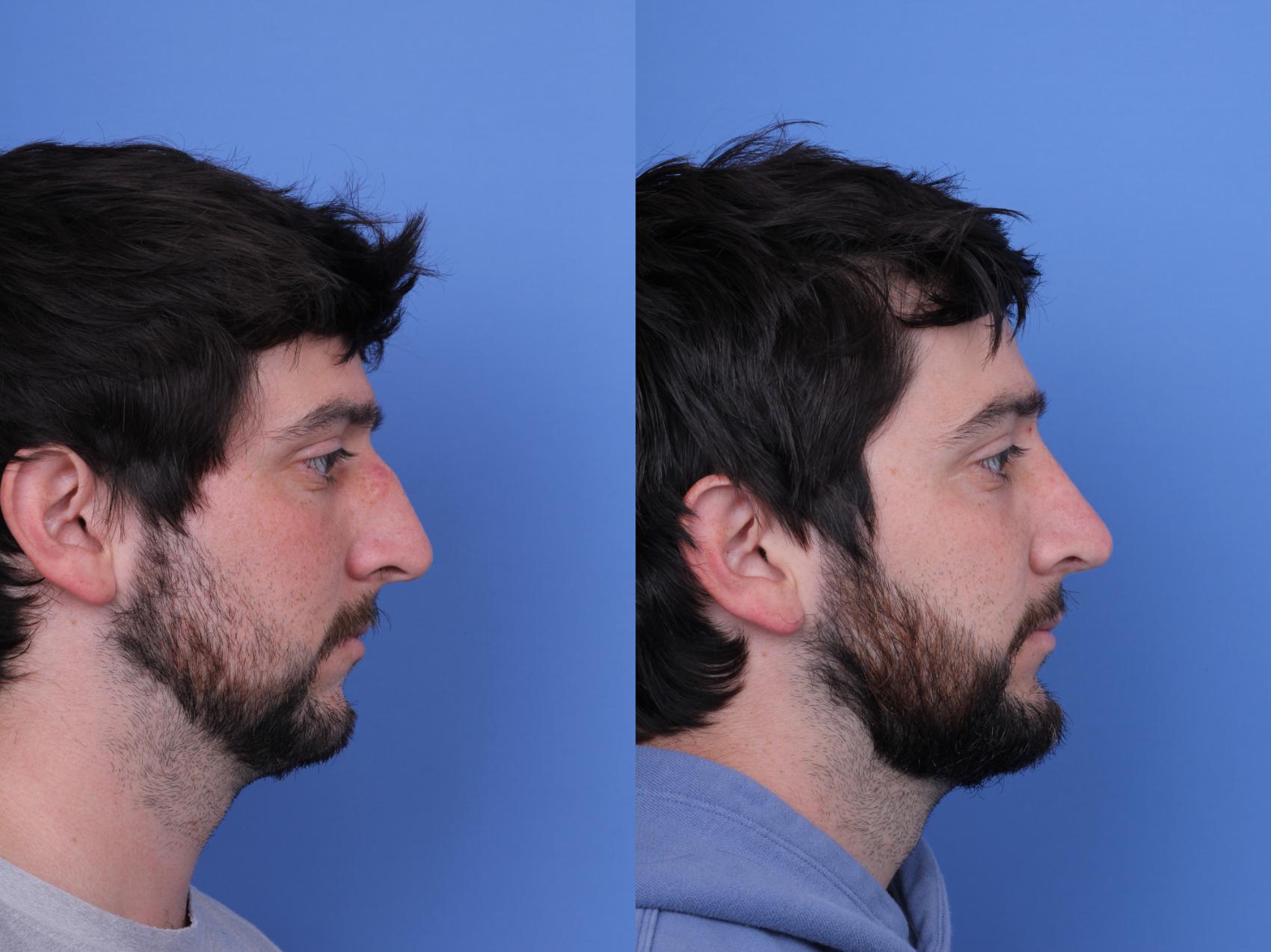 Before & After Rhinoplasty Case 684 Right Side View in Scottsdale, AZ