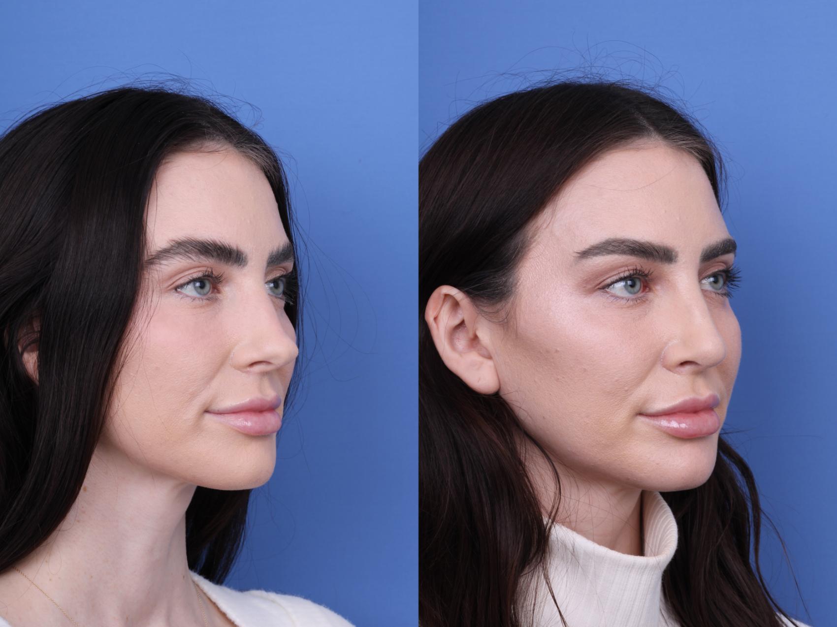 Before & After Rhinoplasty Case 688 Right Oblique View in Scottsdale, AZ