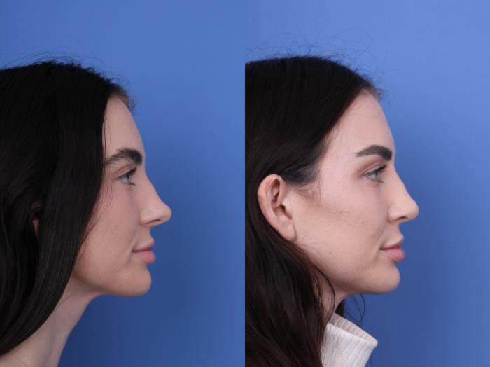 Before & After Rhinoplasty Case 688 Right Side View in Scottsdale, AZ