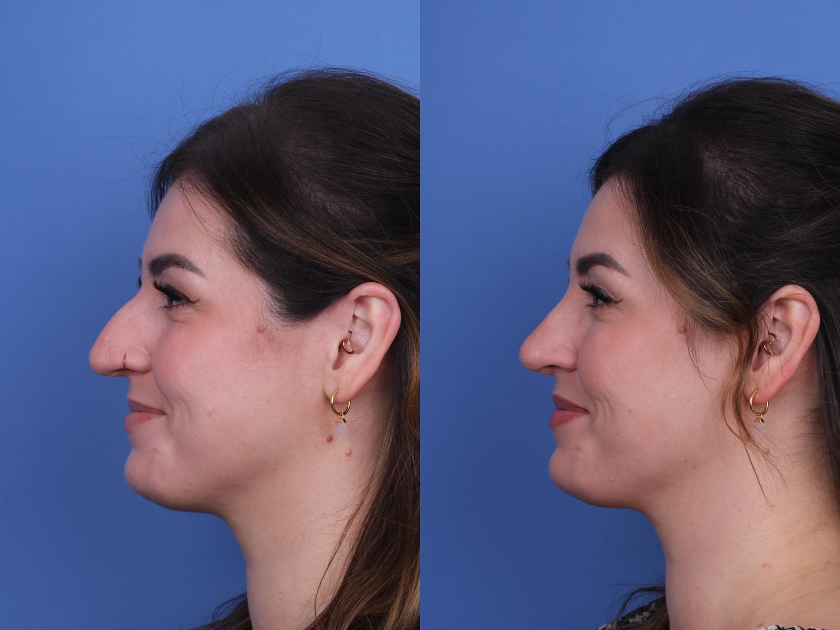 Before & After Rhinoplasty Case 690 Left Smile View in Scottsdale, AZ