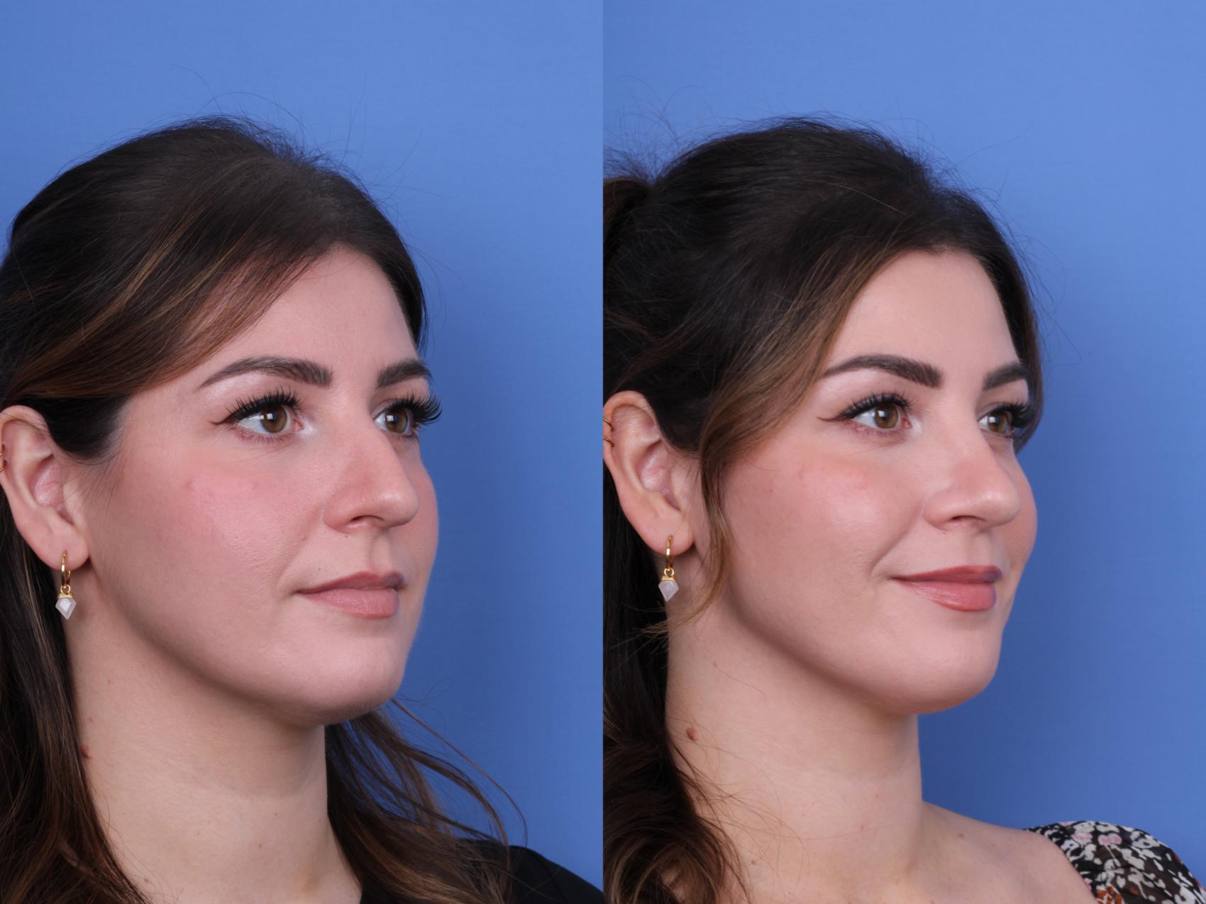 Before & After Rhinoplasty Case 690 Right Oblique View in Scottsdale, AZ