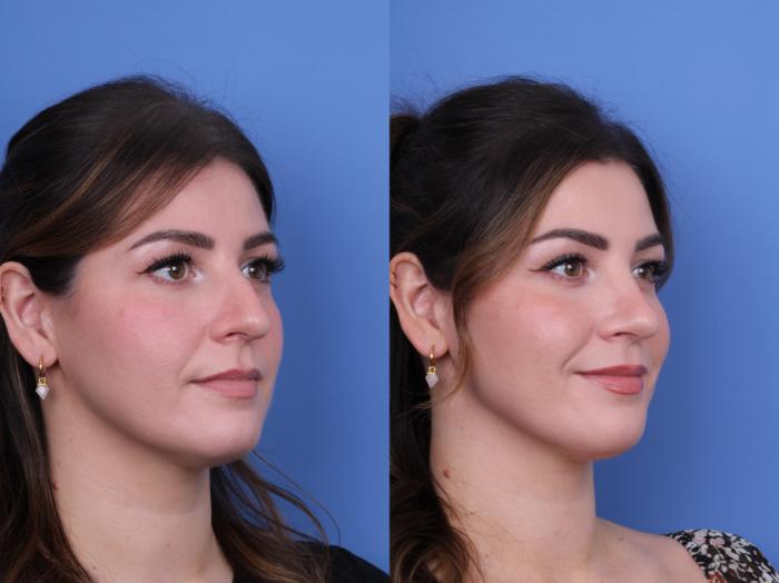 Before & After Rhinoplasty Case 690 Right Oblique View in Scottsdale, AZ