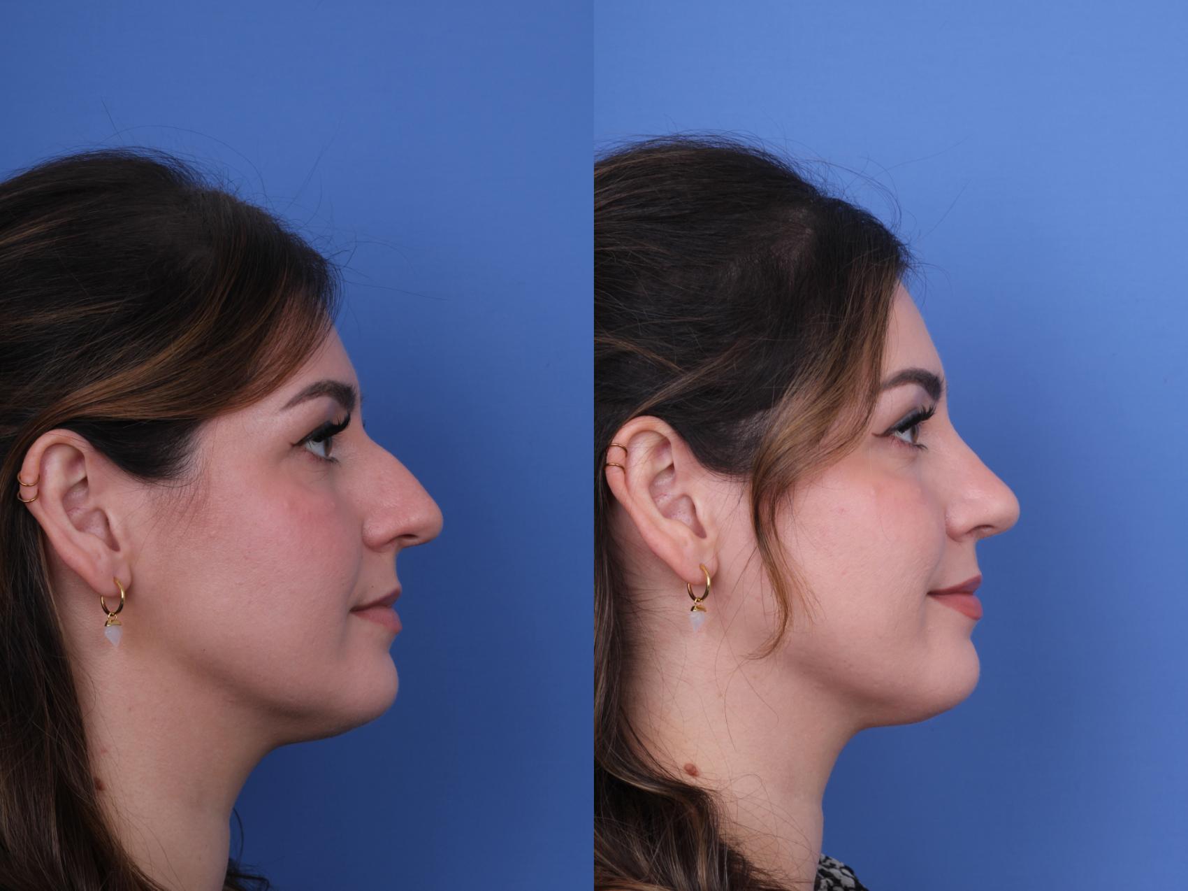 Before & After Rhinoplasty Case 690 Right Side View in Scottsdale, AZ