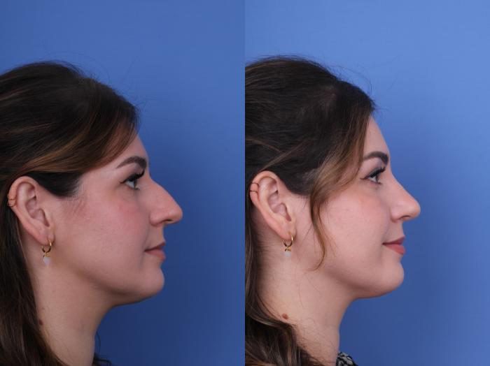 Before & After Rhinoplasty Case 690 Right Side View in Scottsdale, AZ