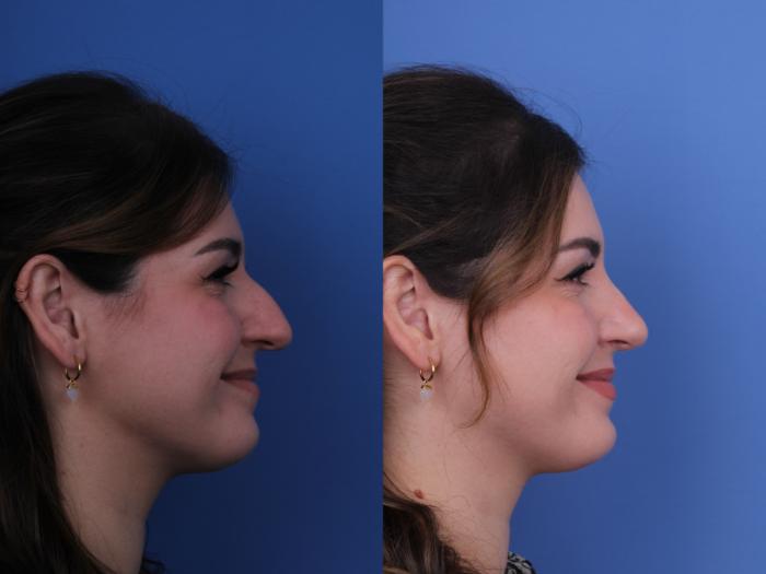 Before & After Rhinoplasty Case 690 Right Smile View in Scottsdale, AZ