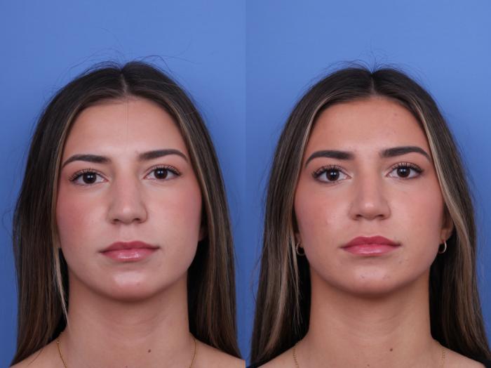 Before & After Rhinoplasty Case 693 Front View in Scottsdale, AZ