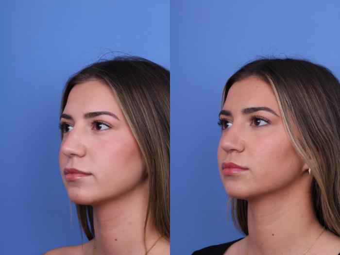 Before & After Rhinoplasty Case 693 Left Oblique View in Scottsdale, AZ
