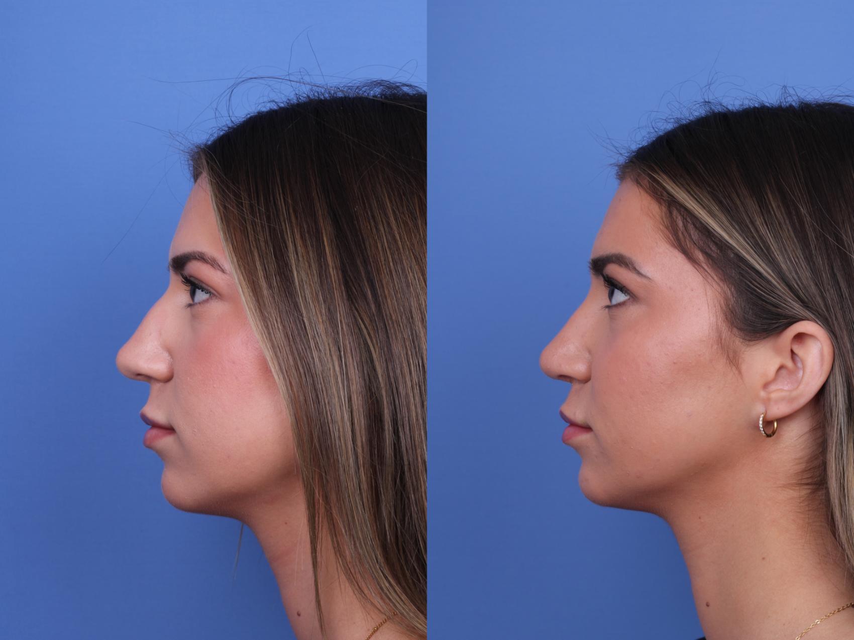 Before & After Rhinoplasty Case 693 Left Side View in Scottsdale, AZ