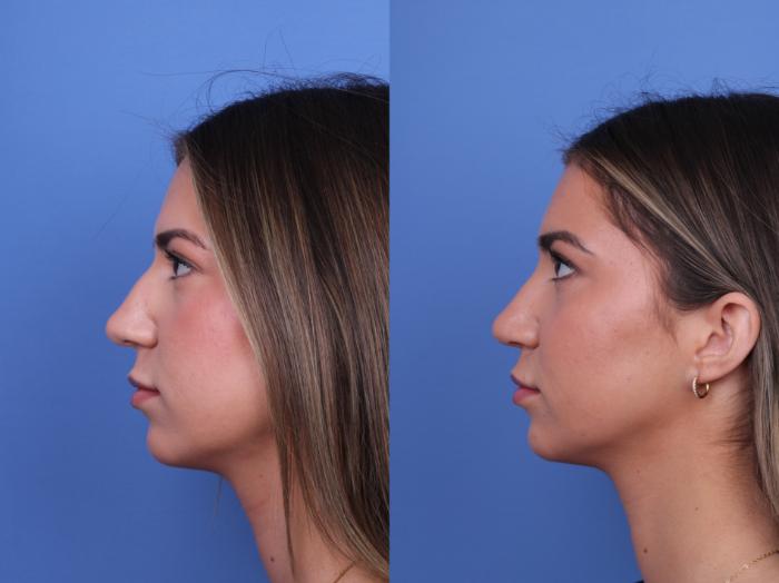 Before & After Rhinoplasty Case 693 Left Side View in Scottsdale, AZ
